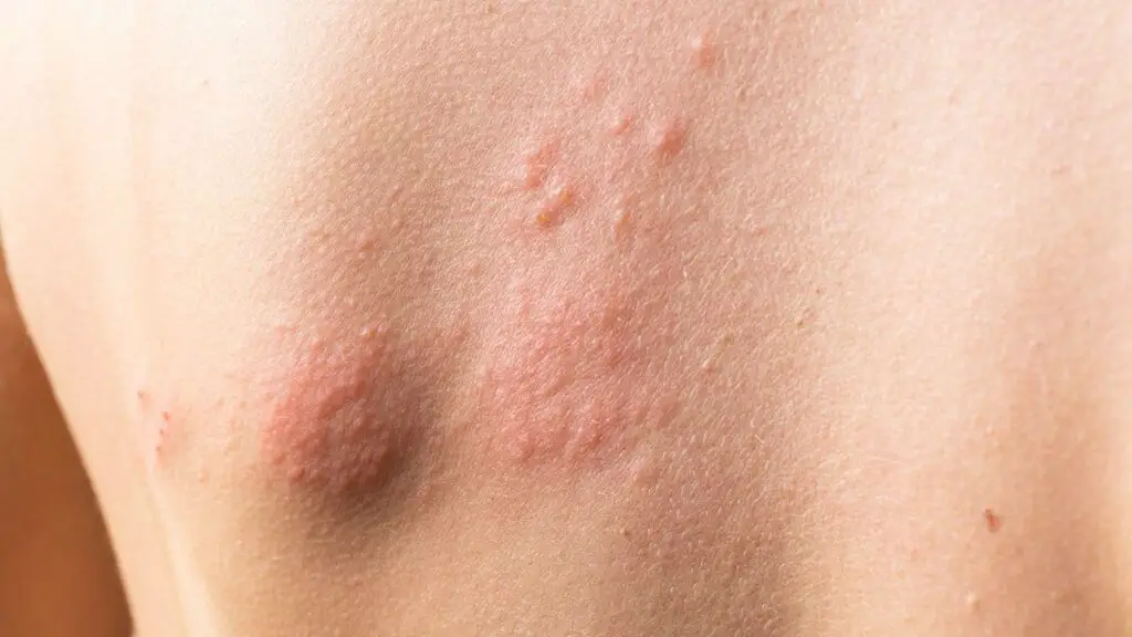 histamine release can cause hives